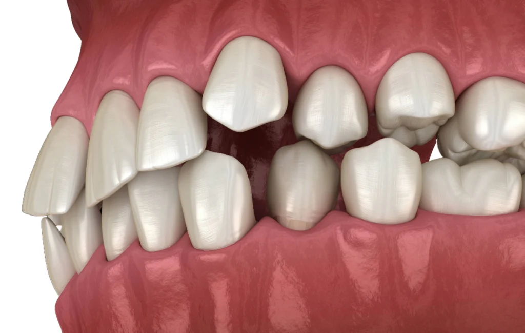 chirurgie guidee optimisation juan les pins chirurgie guidee optimisation juan les pins Occlusodontie Chirurgiens-dentistes à Juan-les-pins | Cabinet dentaire du Lys