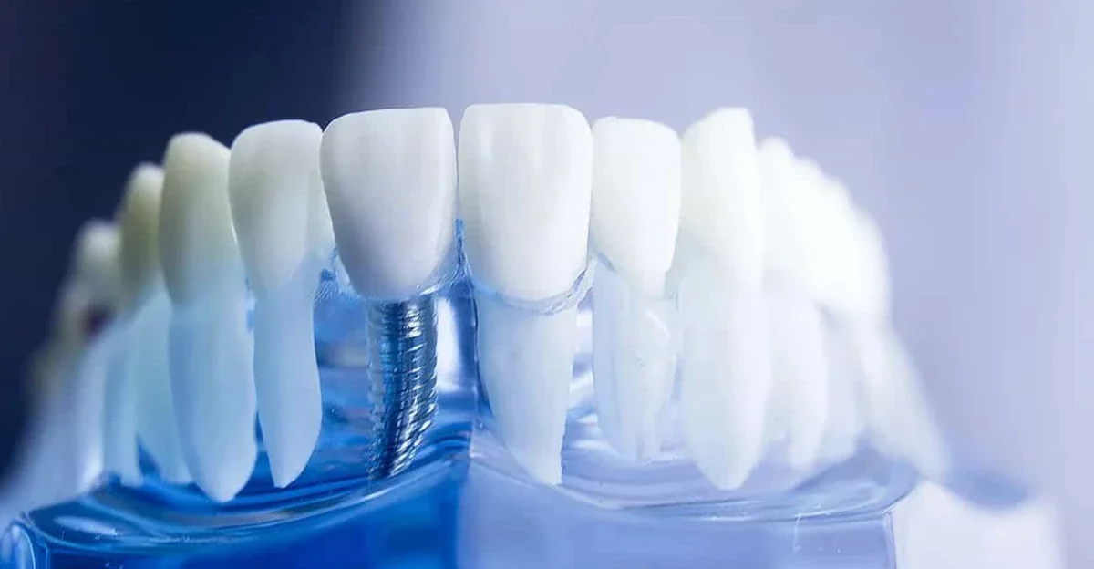 extraction implantation assistance numerique juan les pins Implant dentaire Chirurgiens-dentistes à Juan-les-pins | Cabinet dentaire du Lys