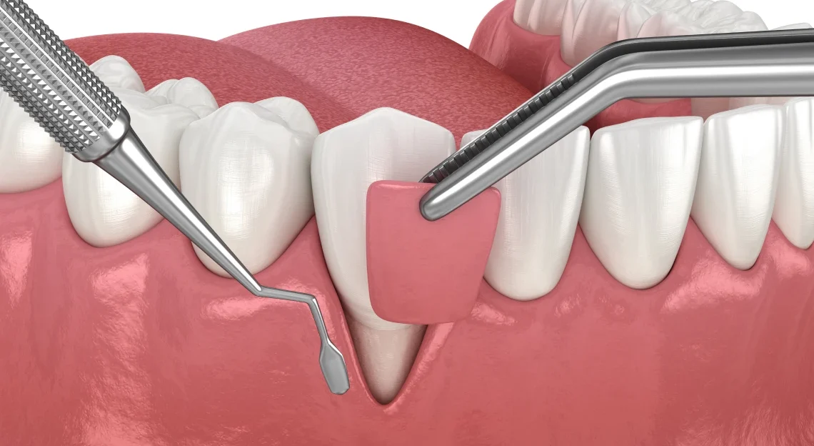 extraction implantation soins implants juan les pins Greffe de gencive Chirurgiens-dentistes à Juan-les-pins | Cabinet dentaire du Lys