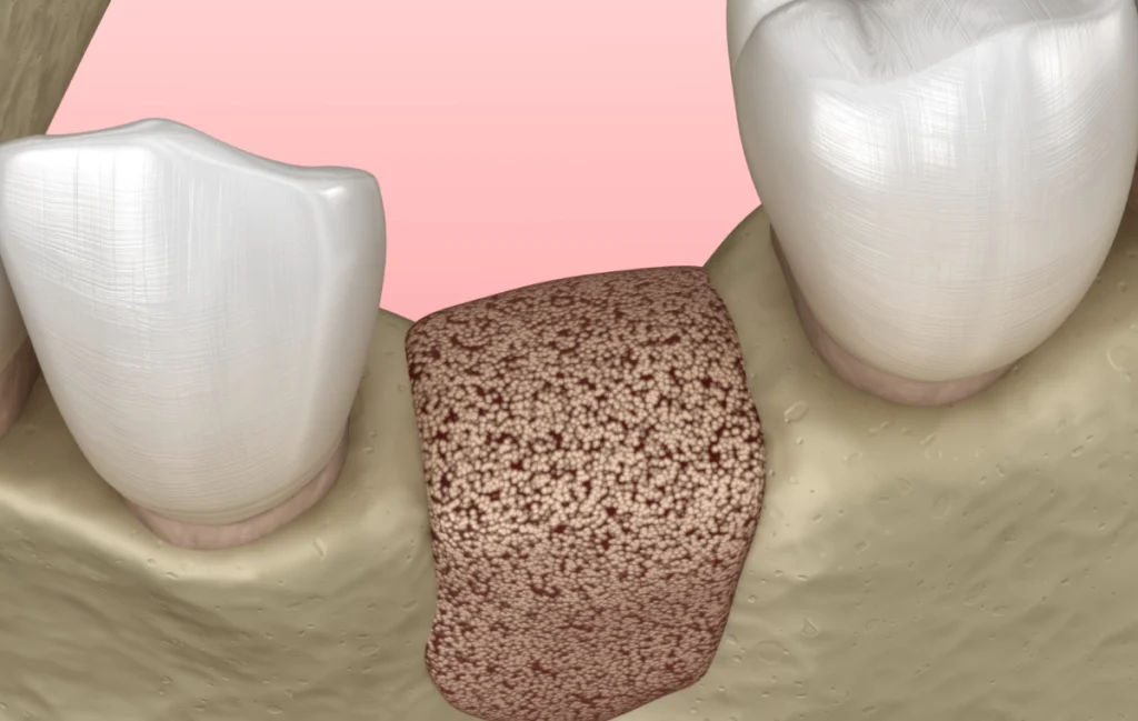 greffe osseuse greffe osseuse Greffe osseuse Chirurgiens-dentistes à Juan-les-pins | Cabinet dentaire du Lys